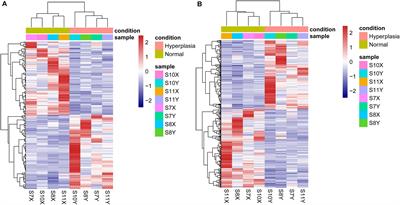 Identification of Critical Genes and Proteins for Stent Restenosis Induced by Esophageal Benign Hyperplasia in Esophageal Cancer